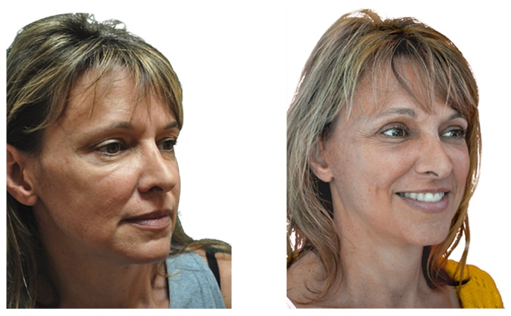 Mini Facelift nyc - Natural Look Institute - Dr. Shahar: mini facelift expert in NYC