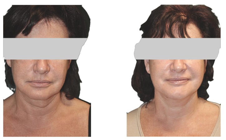 This is a before and after plastic surgery real life picture. Natural Look Institute is a plastic surgery and cosmetic surgery clinic located in New York City. Dr. Shahar is the best plastic surgeon in NYC