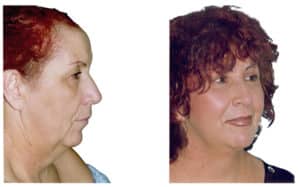 Mini Facelift nyc - Natural Look Institute - Dr. Shahar: mini facelift expert in NYC