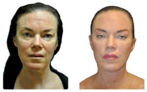 What is mini facelift? A mini facelift is a minimally invasive procedure that is destined  to lift drooping skin on your face. A minifacelift involves a small incision made under the cover of the hair line and around the ears. A mini facelift tightens the underline muscles, and excess skin, defines your jawline, improves your neck laxity and overall look. Before and after mini facelift surgery