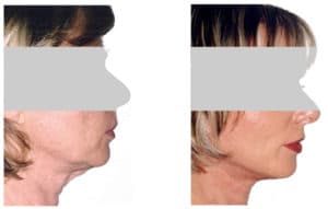 What is mini facelift? A mini facelift is a minimally invasive procedure that is destined  to lift drooping skin on your face. A minifacelift involves a small incision made under the cover of the hair line and around the ears. A mini facelift tightens the underline muscles, and excess skin, defines your jawline, improves your neck laxity and overall look. Before and after mini facelift surgery