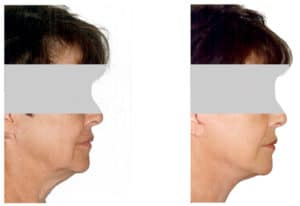 What is mini facelift? A mini facelift is a minimally invasive procedure that is destined  to lift drooping skin on your face. A minifacelift involves a small incision made under the cover of the hair line and around the ears. A mini facelift tightens the underline muscles, and excess skin, defines your jawline, improves your neck laxity and overall look. Before and after mini facelift surgery