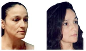 Fat injections face before and after