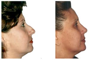 What is rhinoplasty? Rhinoplasty before and after. Before and after nose job by Doctor Shahar. This is a before and after plastic surgery real life picture. Natural Look Institute is a plastic surgery and cosmetic surgery clinic located in New York City. Dr. Shahar is the best plastic surgeon in NYC