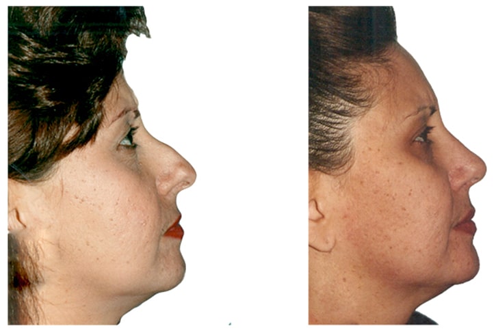 Top Celebrity Rhinoplasty Surgeon, Natural Looking Nose Job Surgery For  Women, Best Revision and Rapid Recovery Rhinoplasty Surgeon In Manhattan,  Upper East Side, New York City, Connecticut, Washington, Boston and New  Jersey.