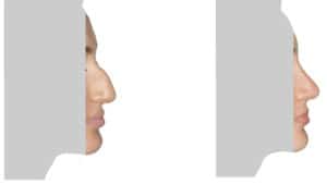 What is rhinoplasty? Rhinoplasty before and after. Before and after nose job by Doctor Shahar. This is a before and after plastic surgery real life picture. Natural Look Institute is a plastic surgery and cosmetic surgery clinic located in New York City. Dr. Shahar is the best plastic surgeon in NYC