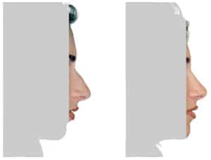 What is rhinoplasty? Rhinoplasty before and after. Before and after nose job by Doctor Shahar
