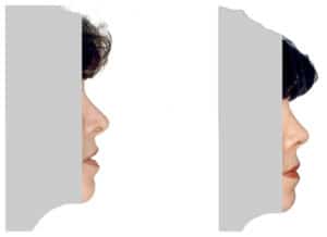 What is rhinoplasty? Rhinoplasty before and after. Before and after nose job by Doctor Shahar