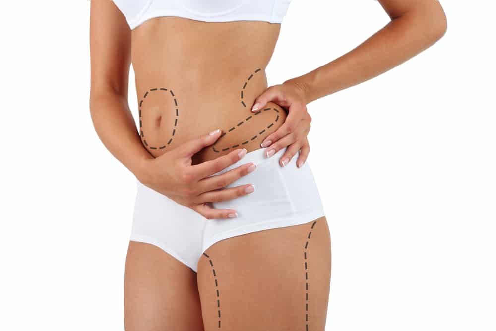 Tummy Tuck or Liposuction? Which Is Right for Your Muffin Top