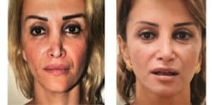 Secondary rhinoplasty, also known as revision rhinoplasty, refers to a corrective nasal surgery performed after an initial rhinoplasty procedure.