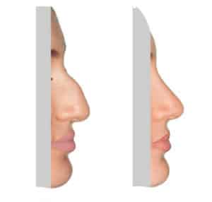This is a before and after rhinoplasty surgery real life picture. Natural Look Institute is a plastic surgery and cosmetic surgery clinic located in New York City. Dr Shahar specializes in Affordable Rhinoplasty (affordable nose jobs).