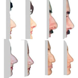 What is rhinoplasty? Rhinoplasty before and after. Before and after nose job by Doctor Shahar