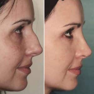 What is rhinoplasty? If you are thinking about getting a nose job (rhinoplasty), you should set up an appointment with Dr. Shahar to discuss it. Dr. Shahar is one of New York City’s best nose job surgeons. During the initial consultation, discuss your goals, fears and mostly discuss what bothers you about your nose and facial features. Rhinoplasty surgery can enhance your natural appearance, but keep in mind that a perfect nose doesn’t exist!