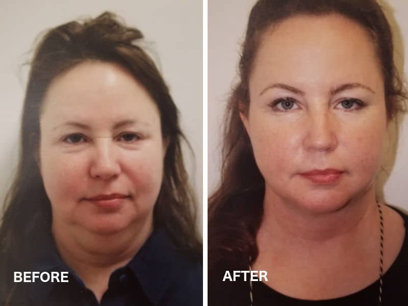 What Is Mini Facelift?  Free Advice, Goals, Risks, Cost