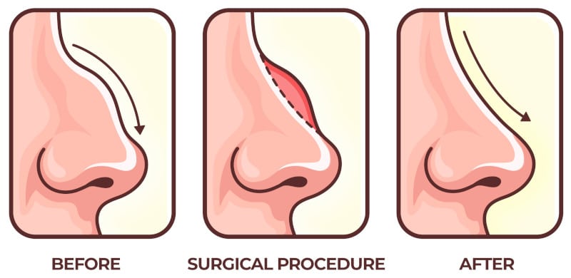Rhinoplasty surgery illustration. Before and after rhinoplasty surgery illustration.