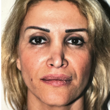 Before_Rhinoplasty_Secondary_Dr Shahar